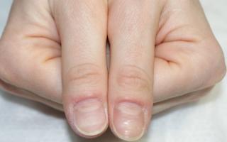 Дистрофия ногтевой пластины лечение